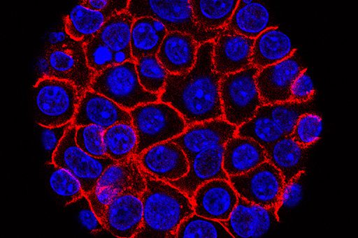 Pancreatic Cancer’s ‘Undruggable’ Curse Meets its Match: A New Pill’s Unsettling Promise