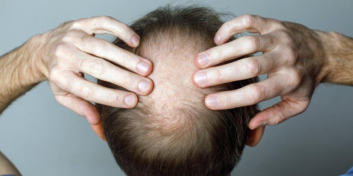 New Study Reveals Weight Loss Drugs May Cause Hair Loss