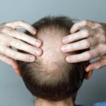 New Study Reveals Weight Loss Drugs May Cause Hair Loss New Study Reveals Weight Loss Drugs May Cause Hair Loss
