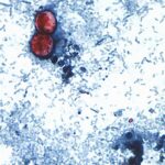 UK Issues Holiday Warning as Cyclospora Outbreak Spreads