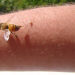 Savannah Spoor Turns to Bee Venom Therapy for Lyme Disease Symptoms Savannah Spoor Turns to Bee Venom Therapy for Lyme Disease Symptoms
