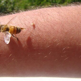 Savannah Spoor Turns to Bee Venom Therapy for Lyme Disease Symptoms