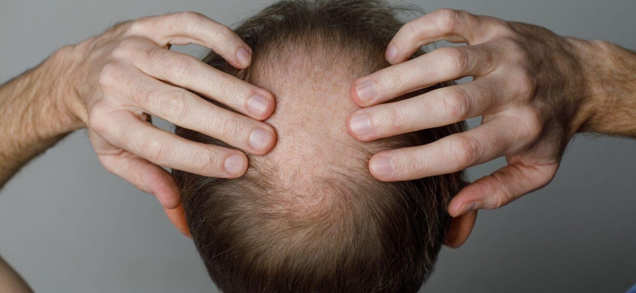 Study Links Weight Loss Medications to Increased Hair Loss Risk