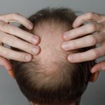 Study Links Weight Loss Medications to Increased Hair Loss Risk