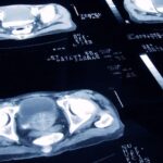 New Prostate Cancer Treatment Equals Radiotherapy Efficacy with Fewer Side Effects