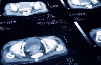 New Prostate Cancer Treatment Equals Radiotherapy Efficacy with Fewer Side Effects
