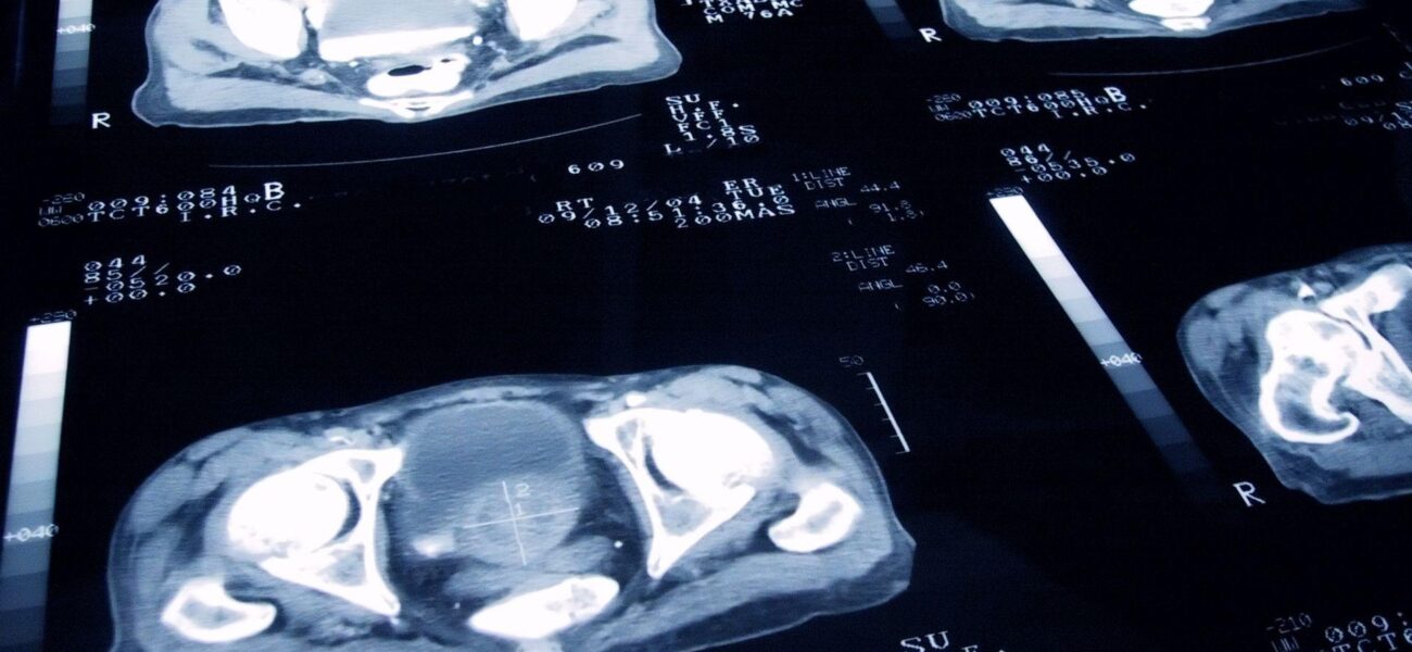 New Prostate Cancer Treatment Shows Comparable Efficacy to Radiotherapy with Fewer Side Effects