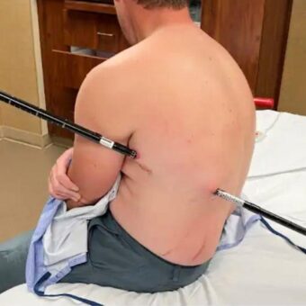 Montana Hiker Impaled by Trekking Pole Successfully Seeks Help