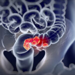 Silent War Within: Gut’s Micro-Citizens Redraw Cancer Battlefield