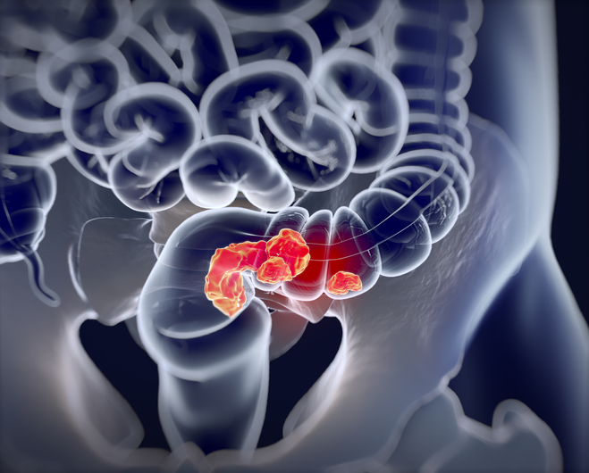 Silent War Within: Gut’s Micro-Citizens Redraw Cancer Battlefield