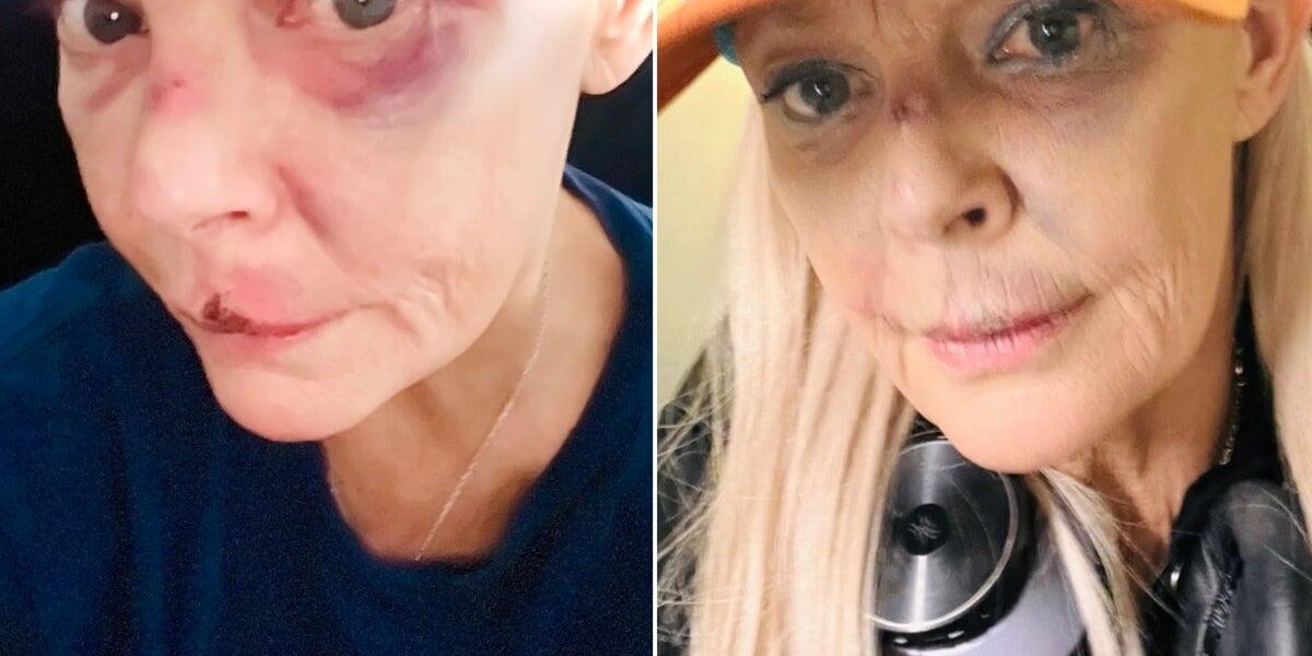 Gail Porter Reveals Gruesome Injuries Following London Incident