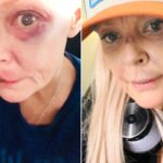 Gail Porter Reveals Gruesome Injuries Following London Incident