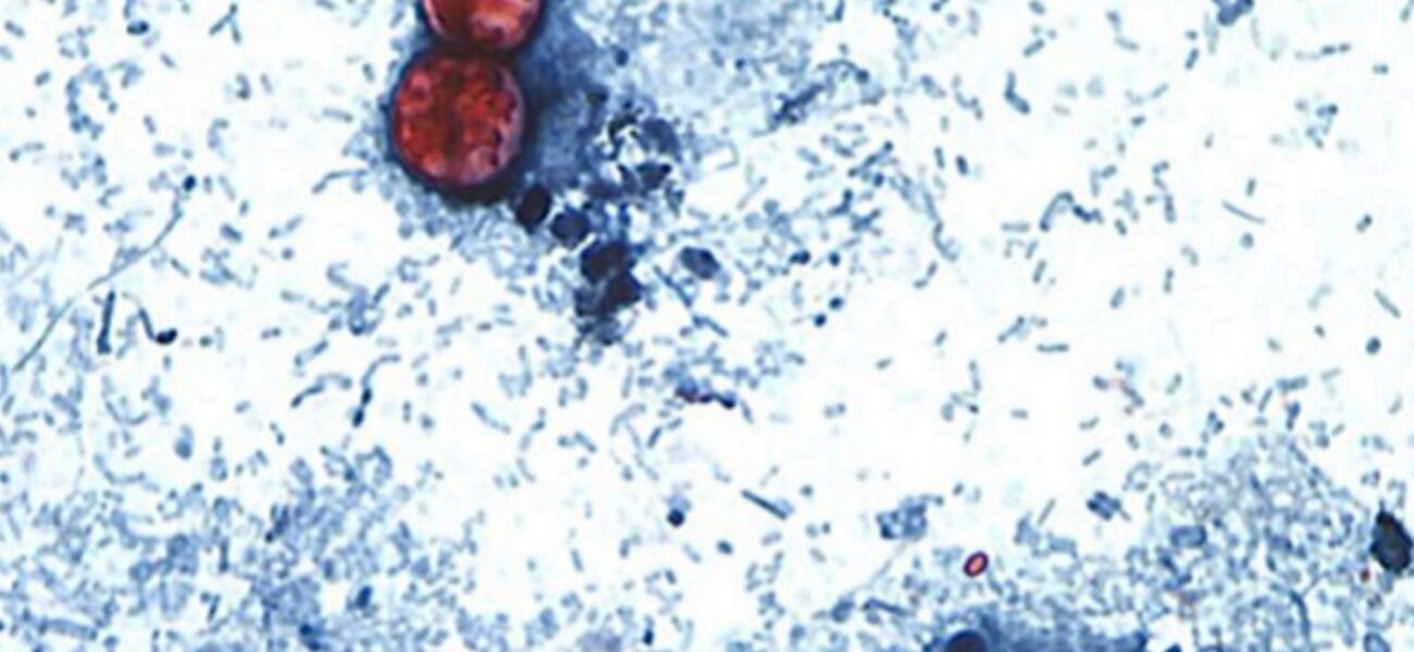 Silent Spoilers: Cyclosporiasis’ Tricky Grip on Global Public Health Systems