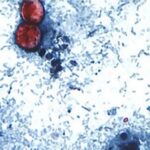 Silent Spoilers: Cyclosporiasis’ Tricky Grip on Global Public Health Systems