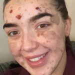 Laura Kelly: Embracing Uniqueness Through Congenital Melanocytic Naevus Journey