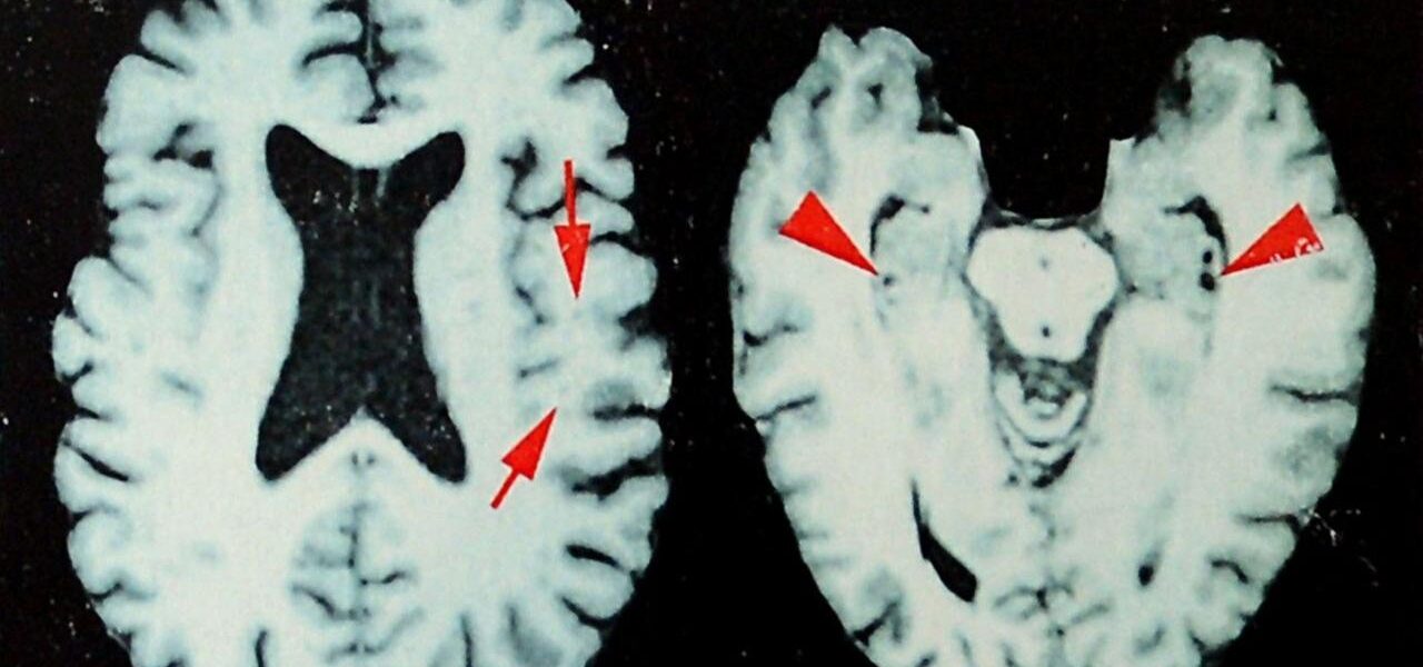Study Reveals Elevated Rates of Degenerative Brain Disease Among Deceased NFL Players Study Reveals Elevated Rates of Degenerative Brain Disease Among Deceased NFL Players