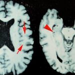 Study Reveals Elevated Rates of Degenerative Brain Disease Among Deceased NFL Players Study Reveals Elevated Rates of Degenerative Brain Disease Among Deceased NFL Players