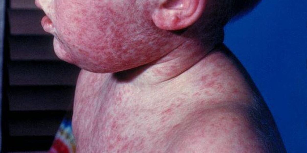 Pennsylvania Records First Measles Deaths in 35 Years