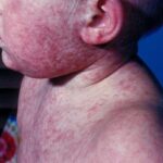 Pennsylvania Records First Measles Deaths in 35 Years