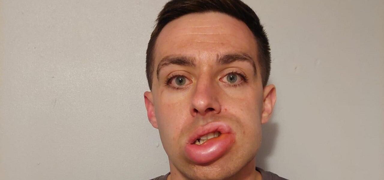 Hereditary Angioedema Patient Finds Relief in Addenbrooke’s Hospital Trial