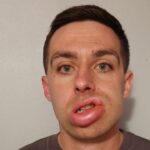 Hereditary Angioedema Patient Finds Relief in Addenbrooke’s Hospital Trial Hereditary Angioedema Patient Finds Relief in Addenbrooke’s Hospital Trial