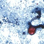 US State Faces Crisis as ‘Explosive Diarrhoea’ Infection Surges, Claiming Two Lives US State Faces Crisis as ‘Explosive Diarrhoea’ Infection Surges, Claiming Two Lives