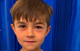 Four-Year-Old Hospitalized After Counterfeit Toy Explodes Four-Year-Old Hospitalized After Counterfeit Toy Explodes