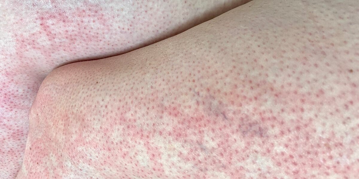 Doctors Warn of ‘Toasted Skin Syndrome’ in Children from Device Overuse Doctors Warn of ‘Toasted Skin Syndrome’ in Children from Device Overuse