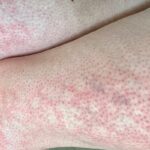 Doctors Warn of ‘Toasted Skin Syndrome’ in Children from Device Overuse